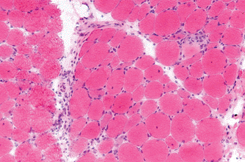 Imagen: Microfotografía de la dematomiosistis de una biopsia muscular (Fotografía cortesía de Nephron).